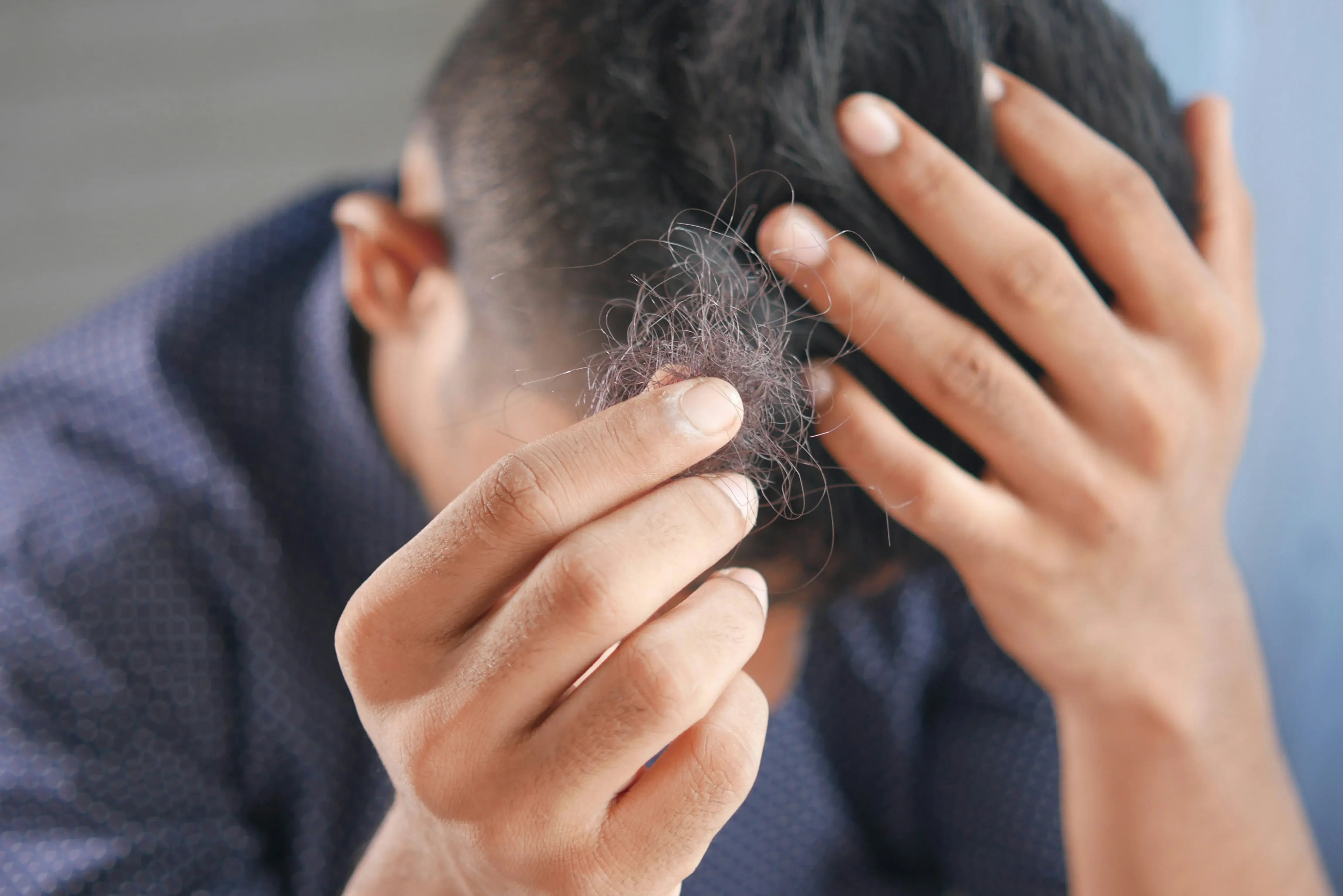 Close up of man holding hair from hair loss