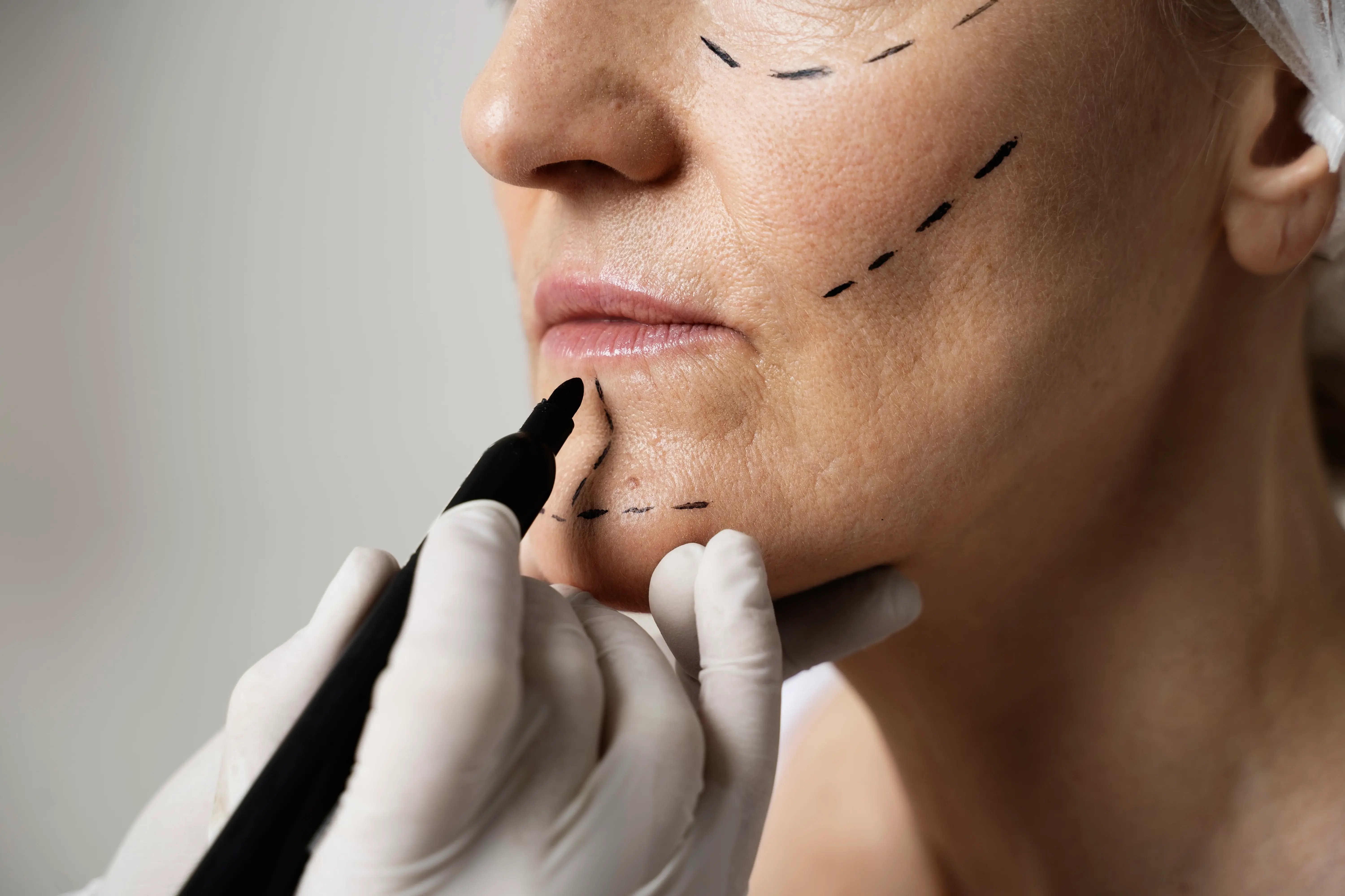 Sculptra treatment outline