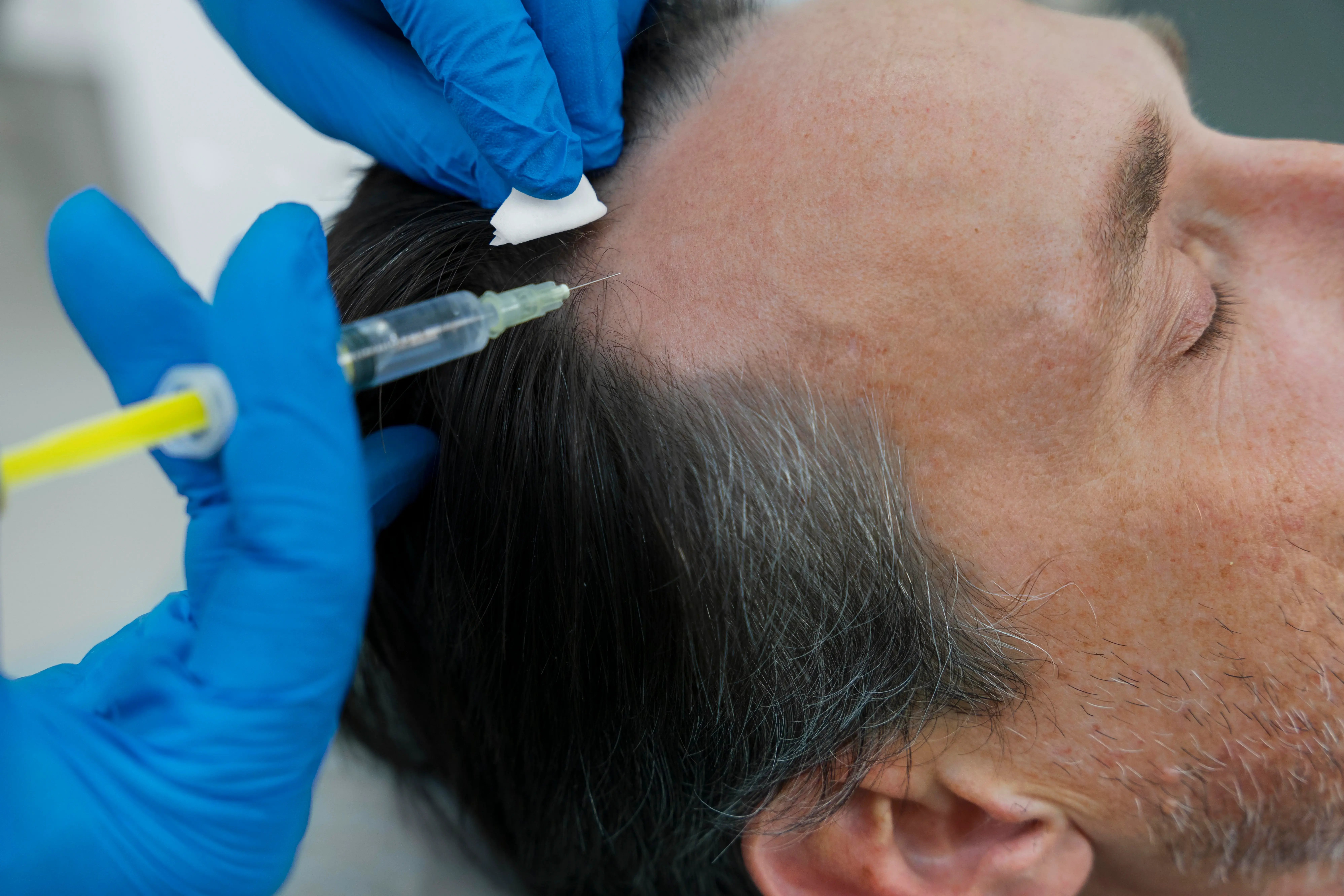 Man receiving hair loss treatment through PRP webp