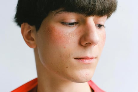 boy with redness on cheeks