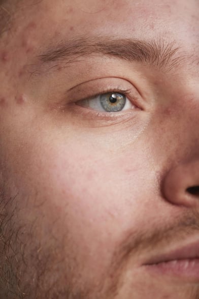 close up of man with acne scars-1