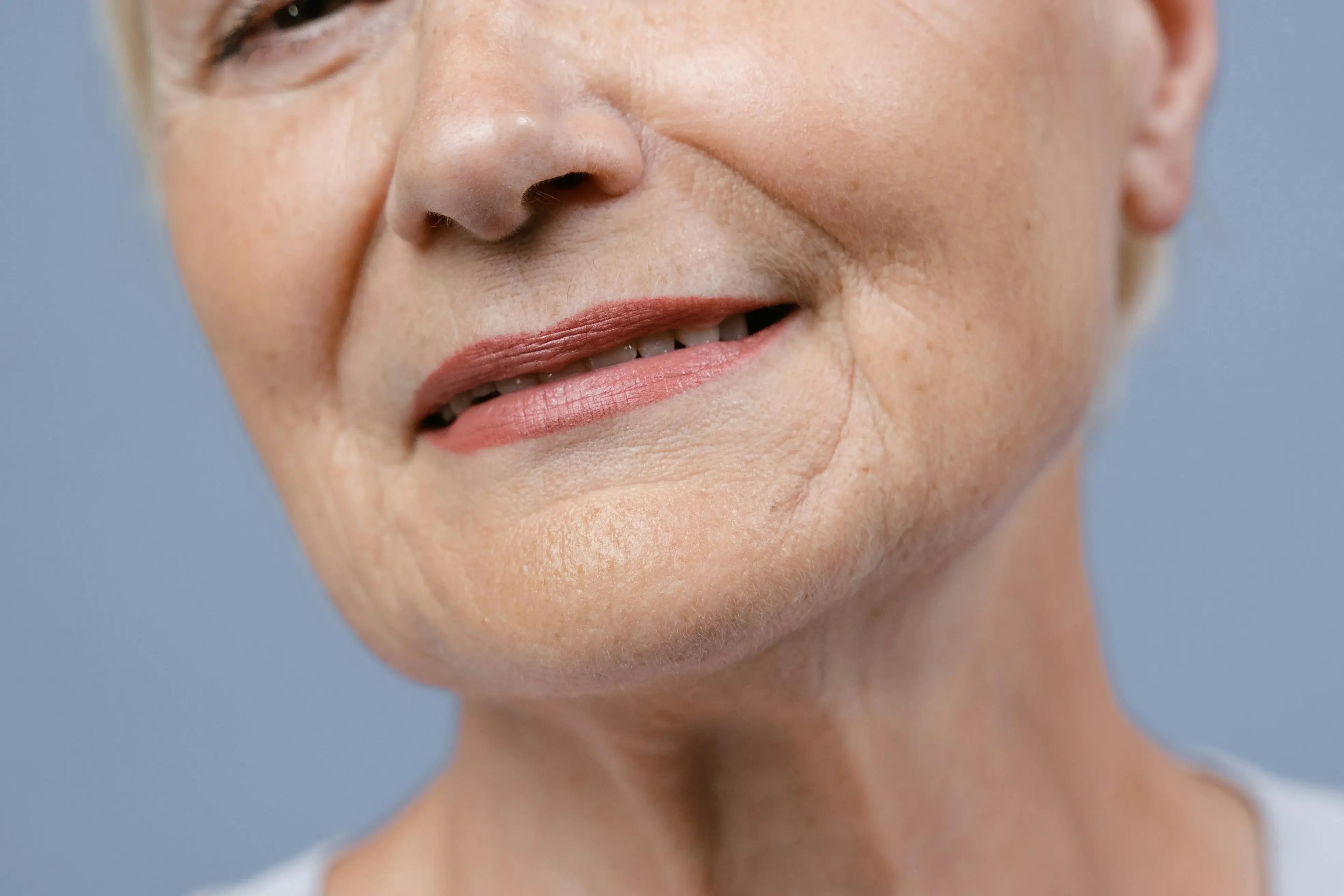 close up of older women smiling with marionette lines before procedure