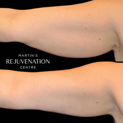 coolsculpting arms before and after