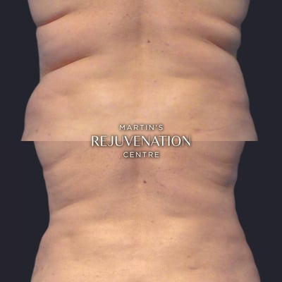 coolsculpting flank before and after