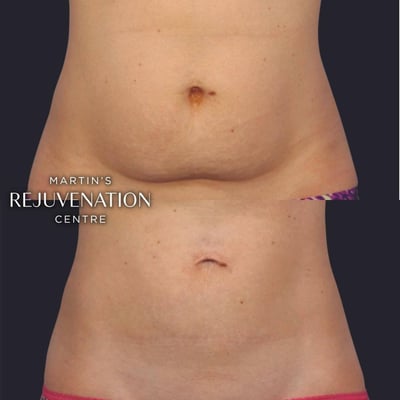 coolsculpting tummy before and after