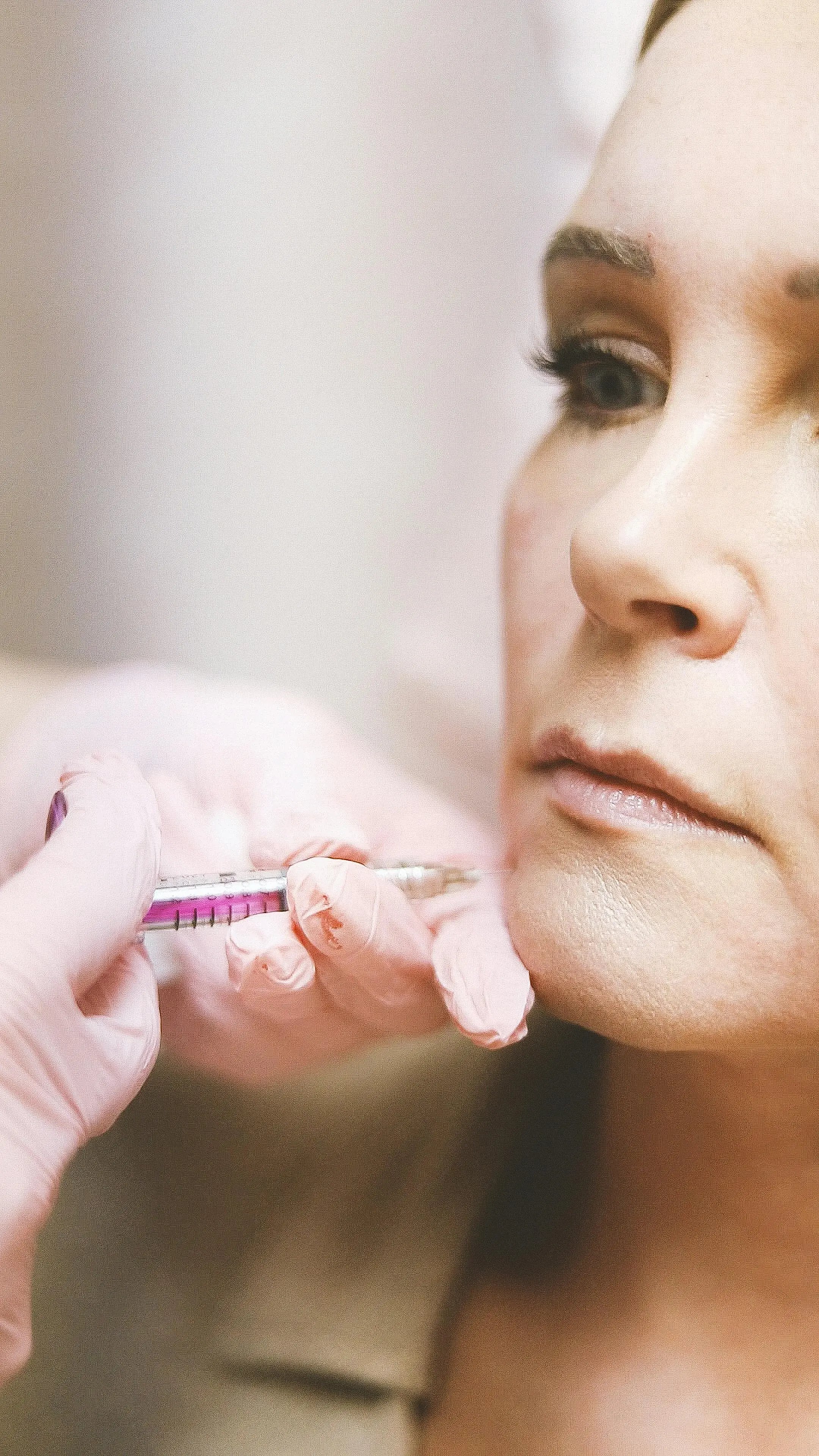 how to smooth marionette lines with dermal filler with Martins