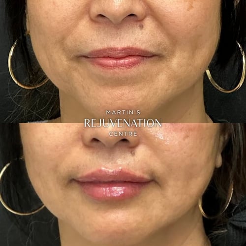 lip augmentation before and after 1