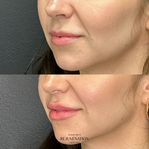 lip augmentation before and after barrie ontario