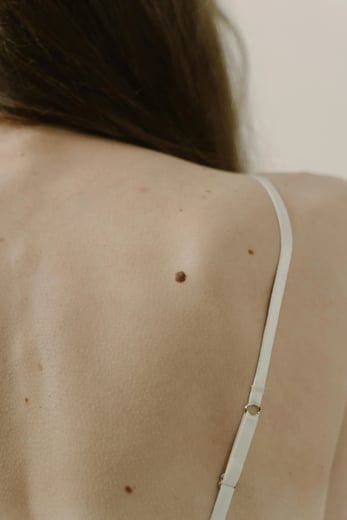 moles on womens back