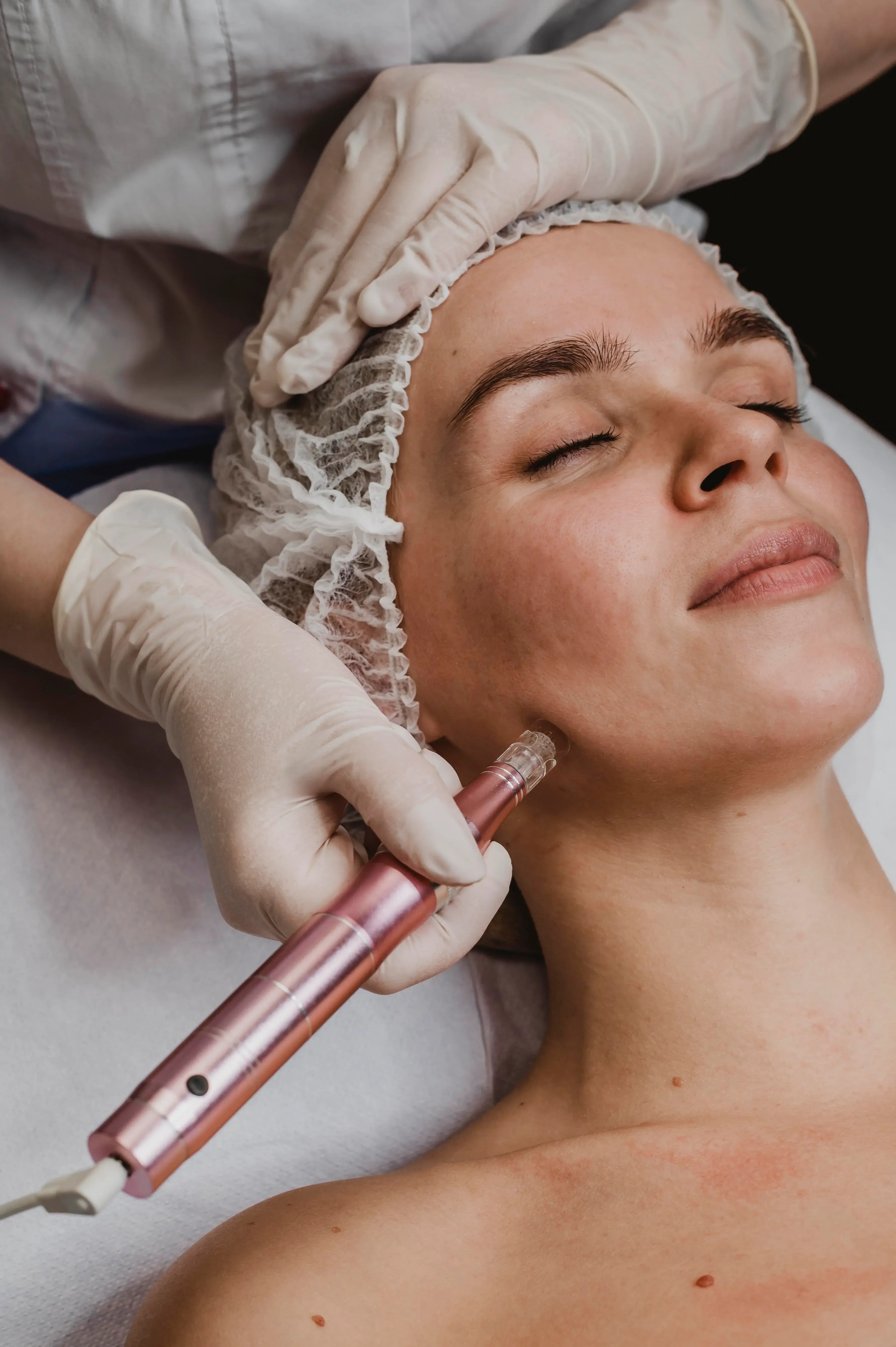 treating acne scars with laser treatment