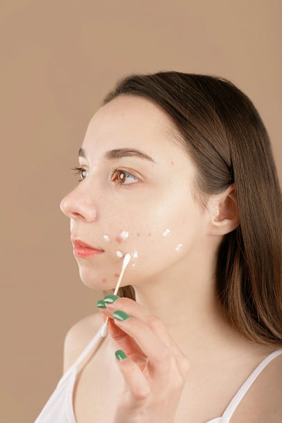 women applying treatment for acne scars