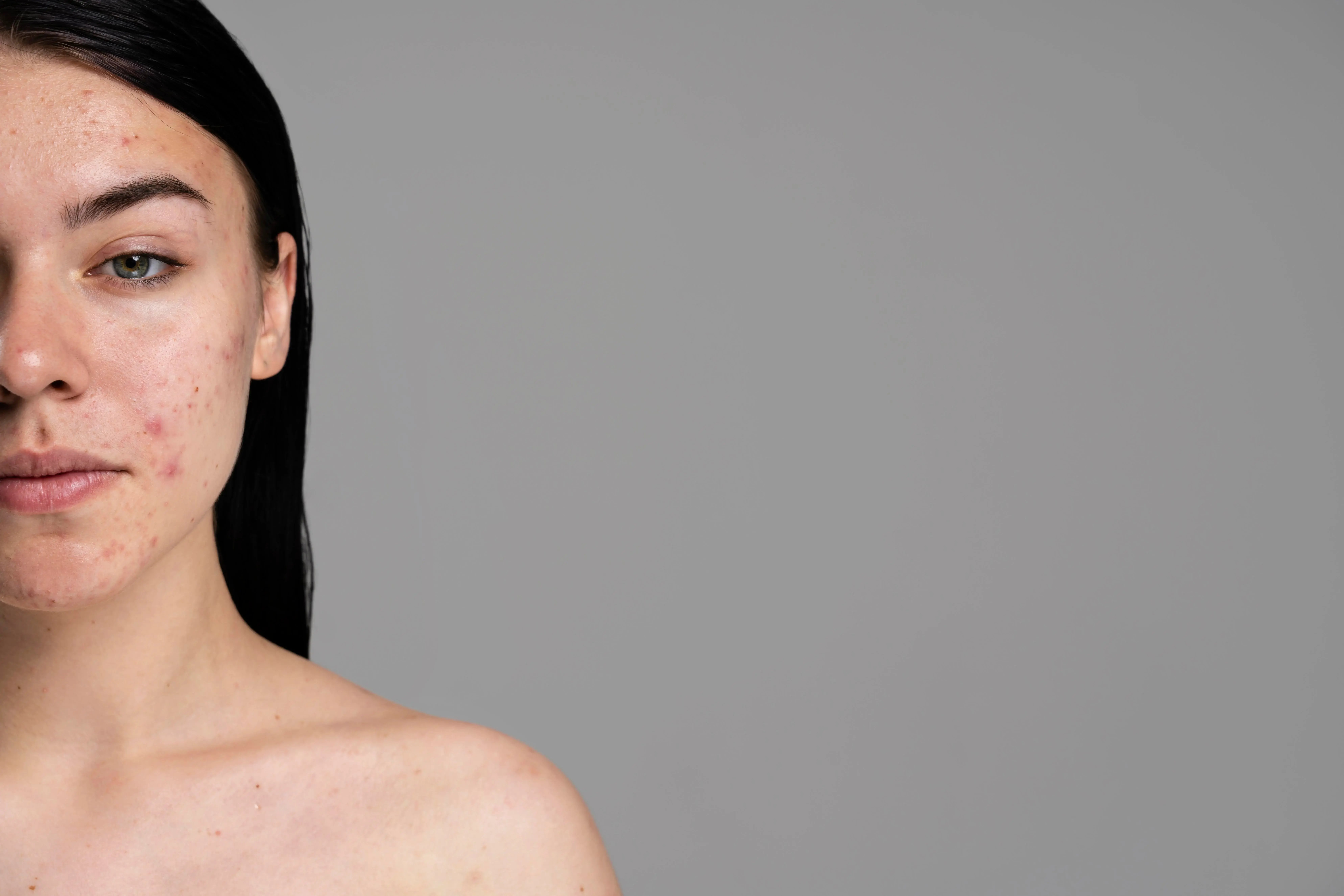 women with acne scarring