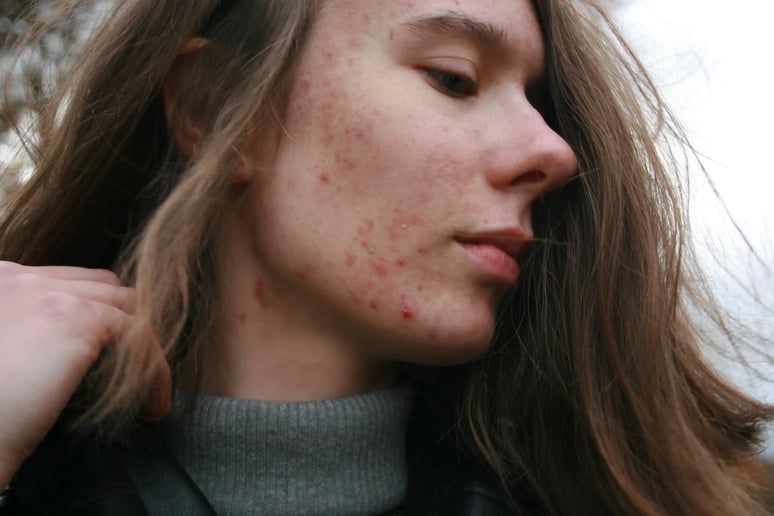 women with acne scars and active acne