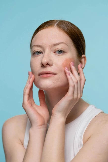 women with redness on cheeks